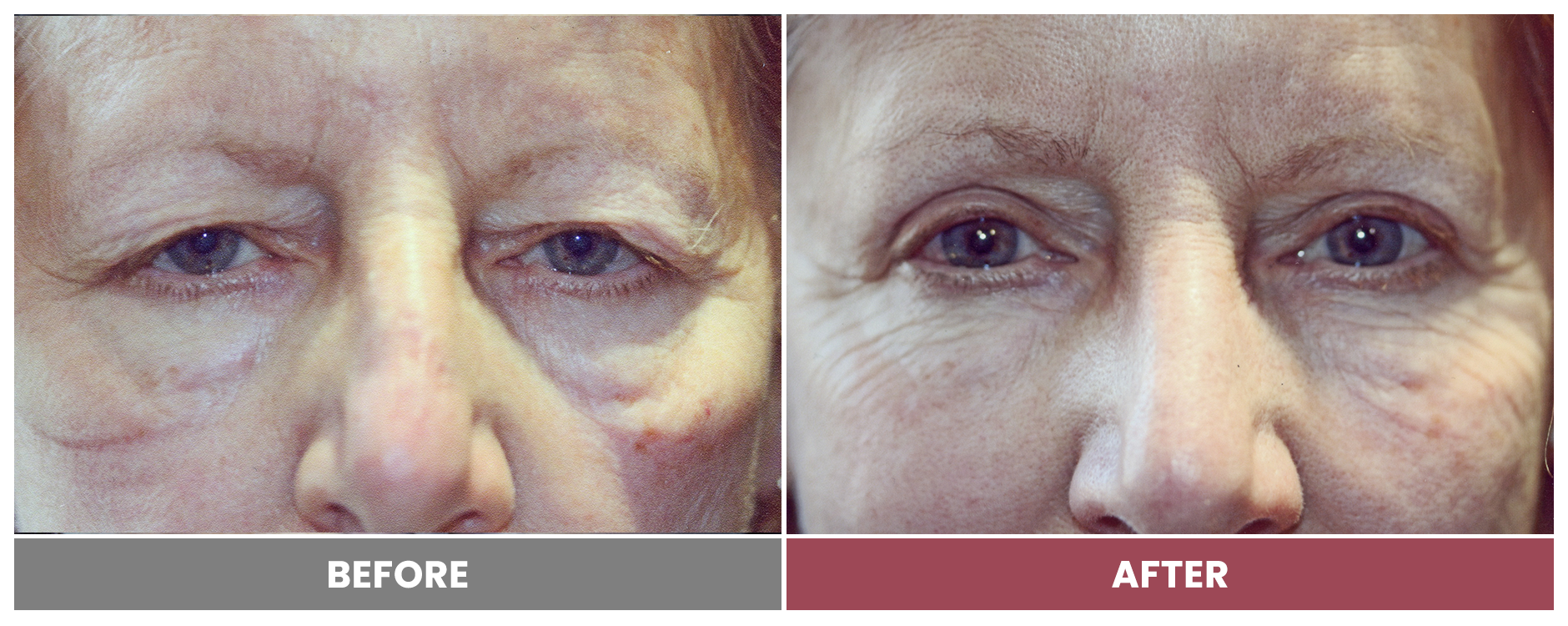 Upper Blepharoplasty - Case 11